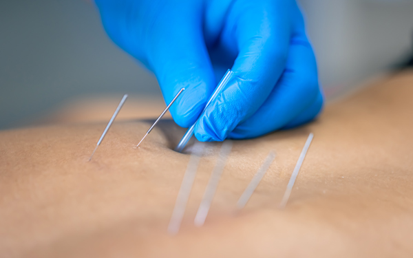 A hand in blue gloves inserts acupuncture needles into skin